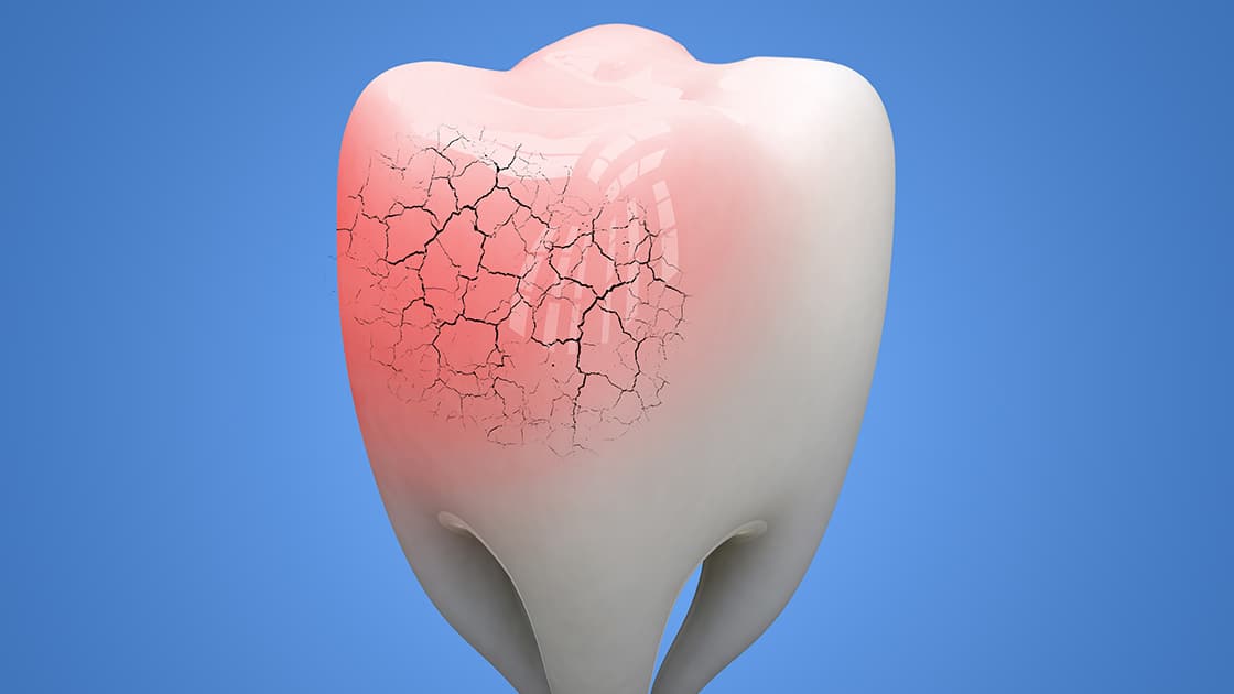 Single Tooth Internal Bleaching